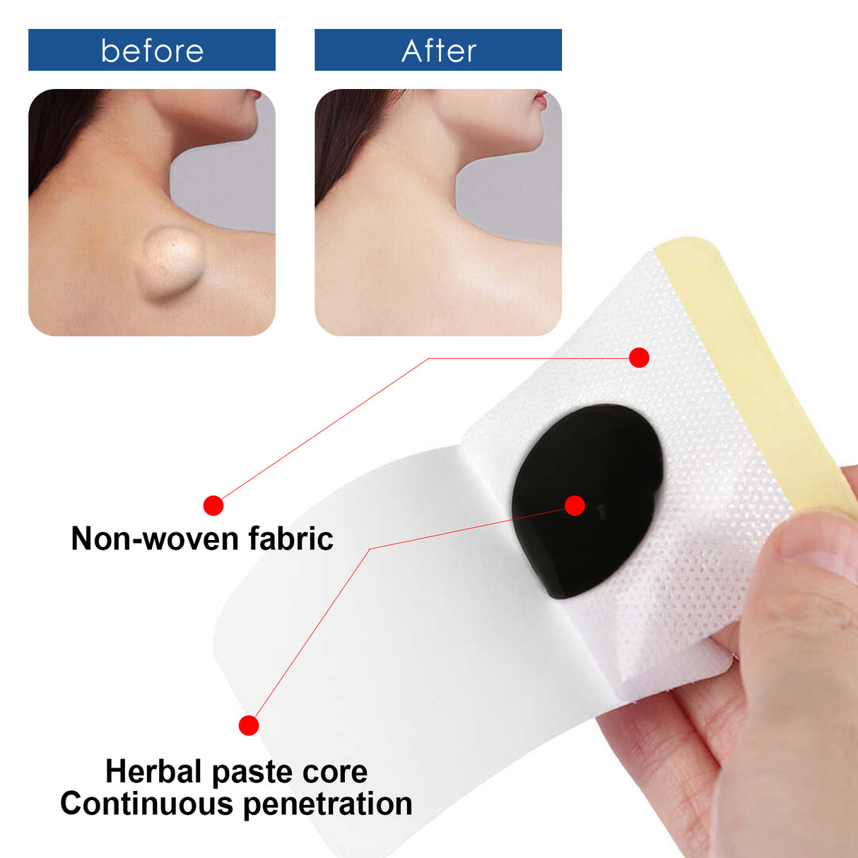 Lipoma Removal Patch, Soothing Various Body Fat Knots To Remove Subcutaneous Lumps Care Patch - V.I.P Digital Presence