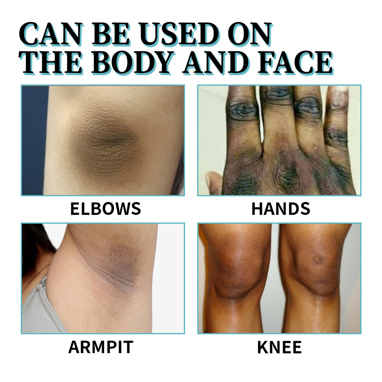 Acanthosis Nigricans Therapy Lotion, Skin Moisturizing Clean Black Dark Heavy Alar Knee Joint Repair Carry Bright Color Of Skin - V.I.P Digital Presence