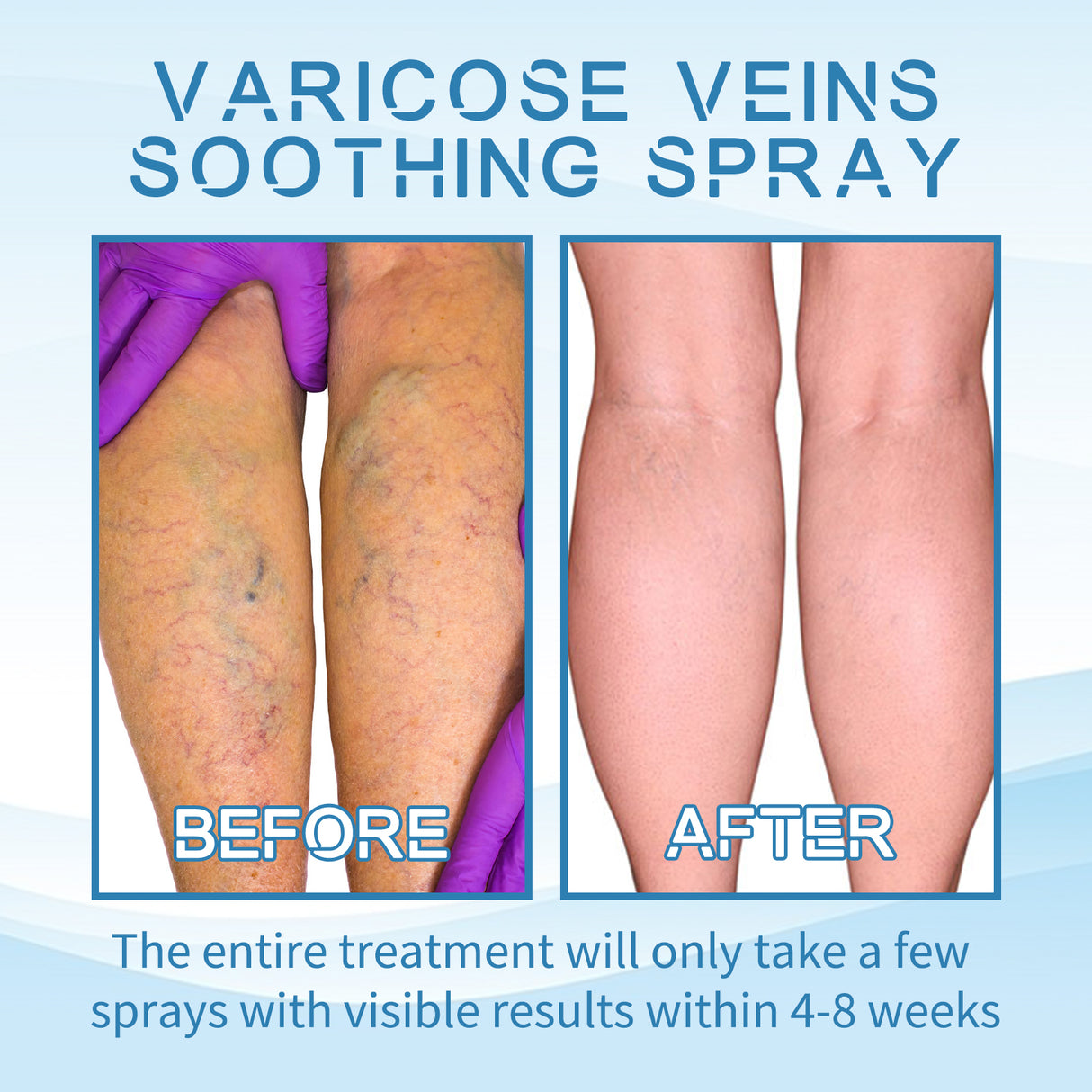Vein Treatment Spray, Relieve Leg Soreness And Swelling Repair Earthworm Leg Vein Treatment Spray - V.I.P Digital Presence