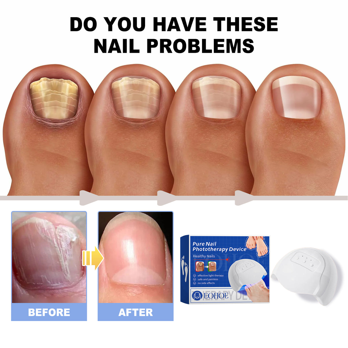 Dispositivo de fototerapia de uñas puro, repara uñas rotas, engrosa y aclara las uñas, limpia suavemente las uñas grises y cuida las uñas.