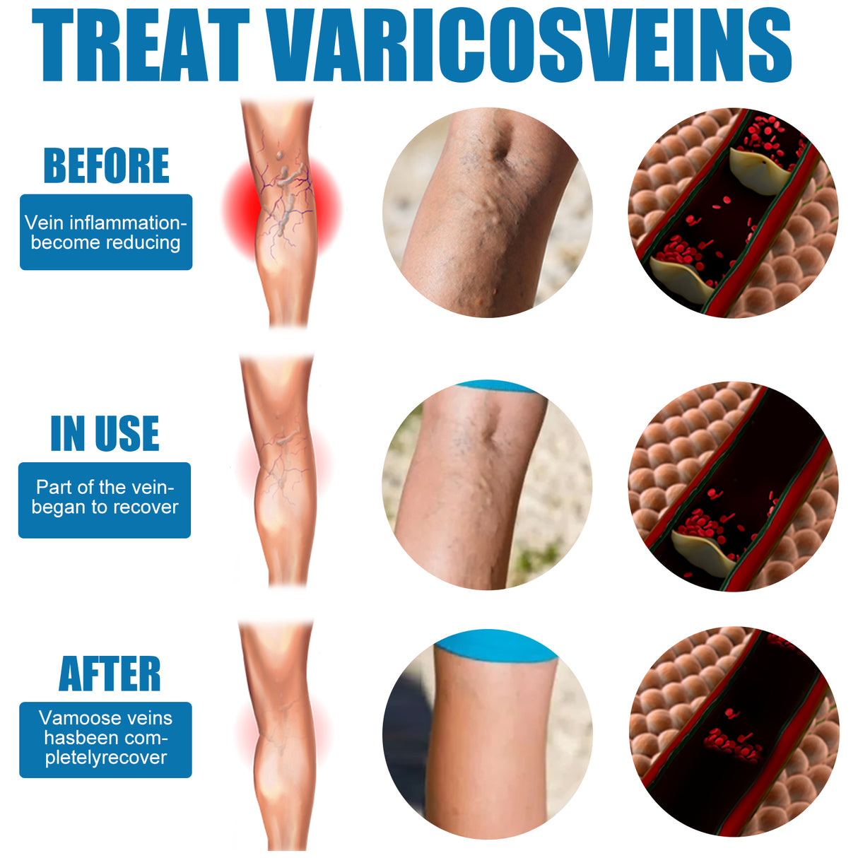 Leg Care Spray Gently Relieve Leg Discomfort, Blue Veins And Bumps Repair Daily Care - V.I.P Digital Presence