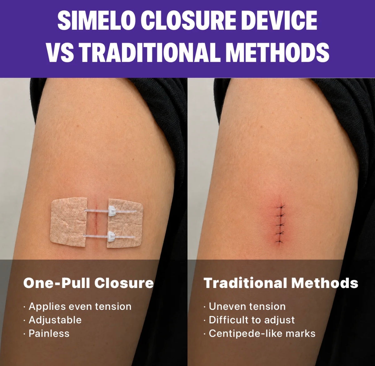 CloseSeal Wound Closure Kit