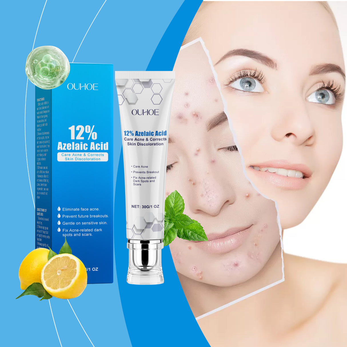 Crema para el acné con ácido azelaico que nutre e hidrata suavemente la piel y equilibra la grasa y el acné. Crema para el acné con ácido azelaico que nutre e hidrata suavemente la piel y equilibra la grasa y el acné.