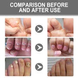 Nail Care Cream, Light Armor Repair Bad Ingrown Nail Nails Brothers Nail Thickening A Ditch Nursing - V.I.P Digital Presence