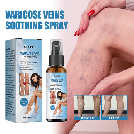 Vein Treatment Spray, Relieve Leg Soreness And Swelling Repair Earthworm Leg Vein Treatment Spray - V.I.P Digital Presence