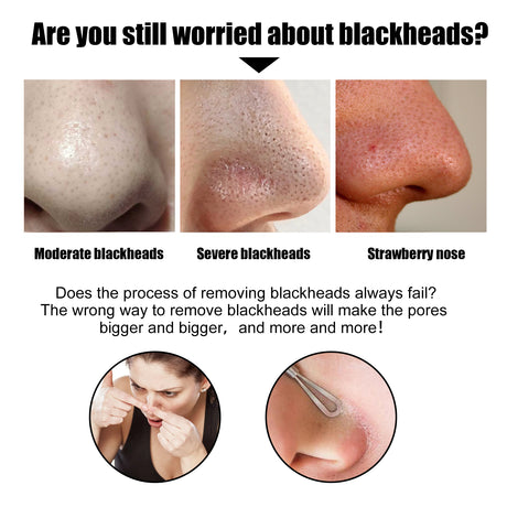 Black Pig Nose Patch, Bamboo Charcoal Remove Blackhead Acne Tear Nose Mask Patch - V.I.P Digital Presence