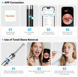 TonsilClear WiFi Stone Remover Kit
