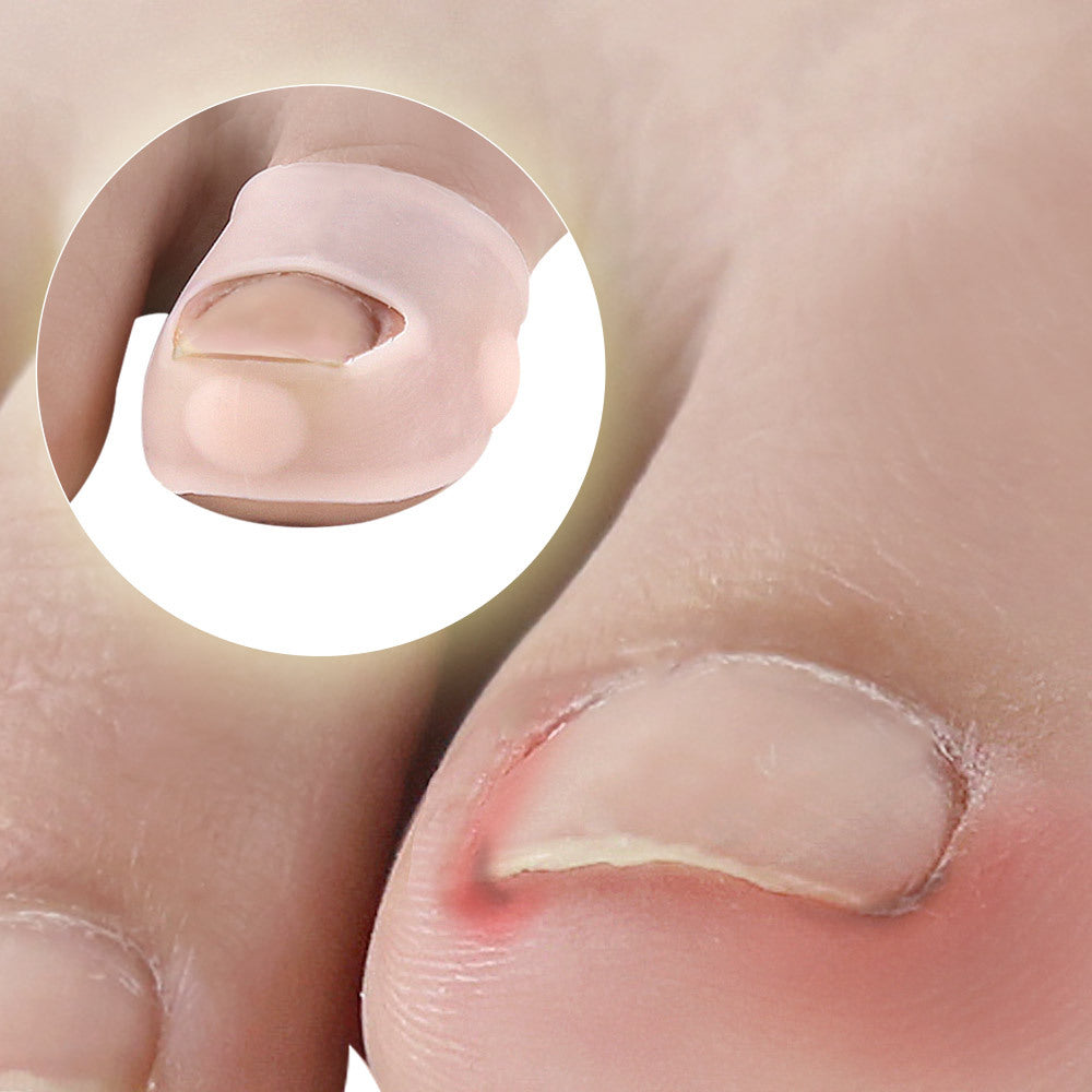 Silicone Inlay Nail Corrector Roll Nail To Correct Nail Pad Nail Groove And Toe To Prevent Nails From Growing Into Flesh - V.I.P Digital Presence