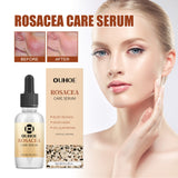 Erythematous Repair Essence, Repair Skin Lighten Facial Erythematous Moisturizing Essential Oil - V.I.P Digital Presence