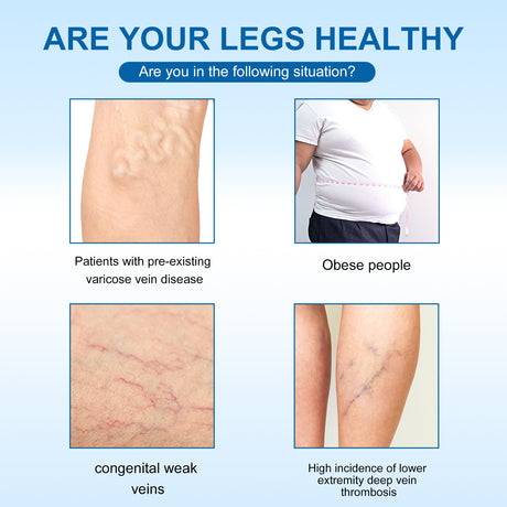 Varicose Vein Slimming Cream, Vein Repair Body Care Reduces Leg Muscle Swelling Earthworm Leg Slimming Cream - V.I.P Digital Presence