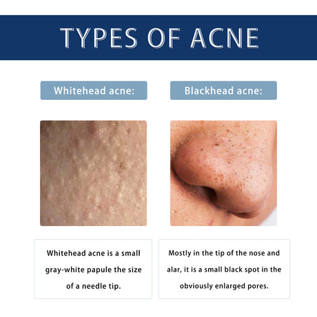 Anti-Pimple Drying Lotion, Facial Cleansing And Repair Lighten Acne Marks And Pits, Close Your Mouth And Mild Skin Cream - V.I.P Digital Presence