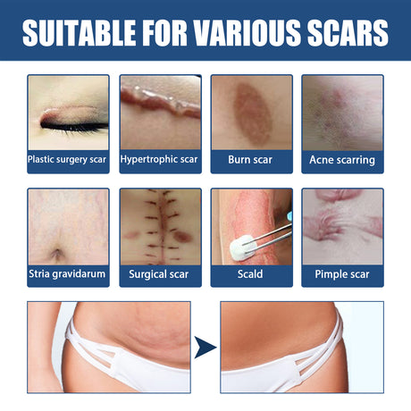 Scar Balm, Surgery Scar Repair Cold Compress Scar Skin Scar Gel Balm - V.I.P Digital Presence