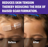 CloseSeal Wound Closure Kit