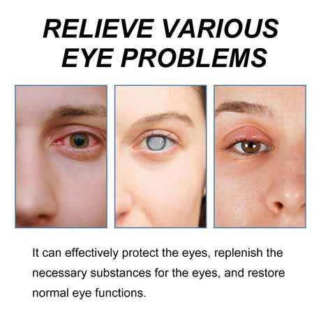 Myopic Eye Drops For Eye Fatigue, Swelling, Swelling, Blurred Vision Mild Eye Drops - V.I.P Digital Presence