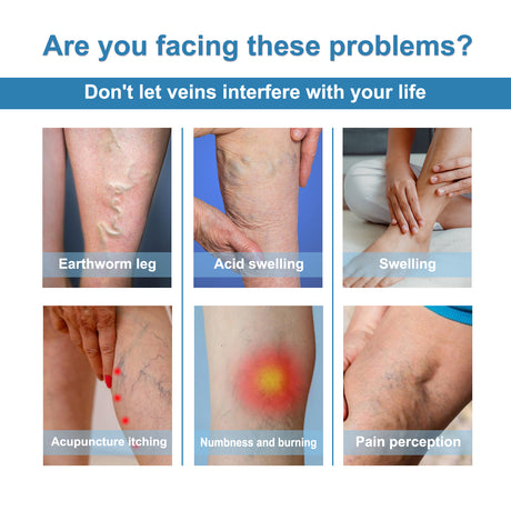 Vein Treatment Spray, Relieve Leg Soreness And Swelling Repair Earthworm Leg Vein Treatment Spray - V.I.P Digital Presence