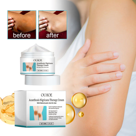 Acanthosis Nigricans Therapy Cream, Repair Dull Skin Lightening Joint Black Moisturizing Whitening Skin Care Cream - V.I.P Digital Presence