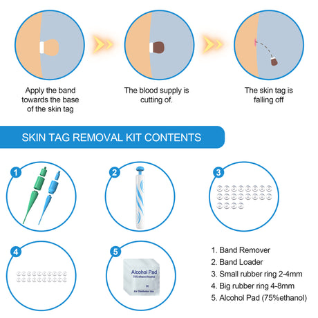 Skin Tag Removal Tool Skin Removing Pen Flesh Nevus Corns And Warts Removing Device - V.I.P Digital Presence