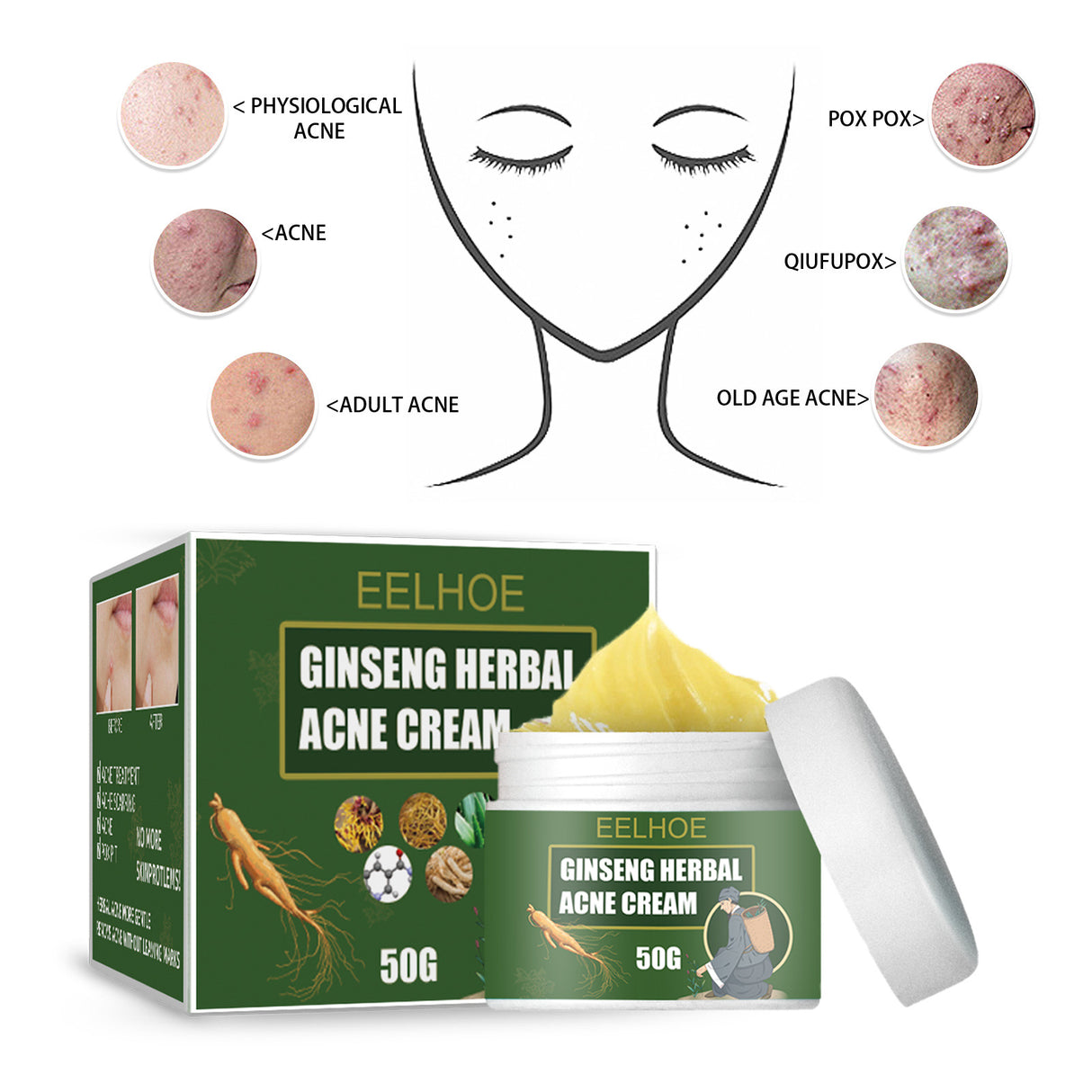 Herbal Acne-Removing Cream Anti-acne-Removing Cream Moisturizing Cleansing Cream Water Oil Balance Anti-acne-Removing Cream - V.I.P Digital Presence