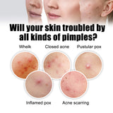 Acne Removal Protection Defense Patch, Color Profile-shaped Portable Invisible Cover Acne Patch - V.I.P Digital Presence