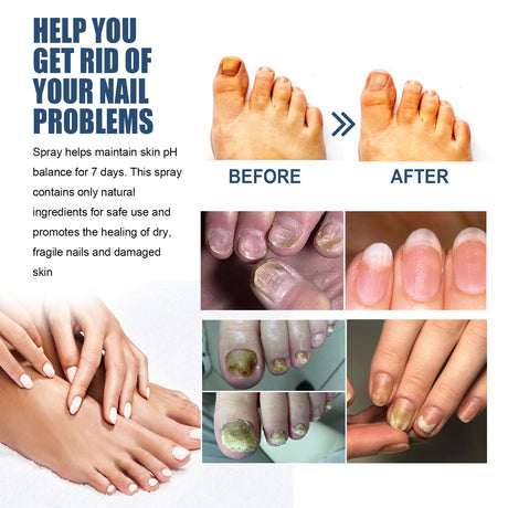 Nail Care Spray Gently Cleans Foot Nails Moisturizing And Brightening Nail Care Spray - V.I.P Digital Presence