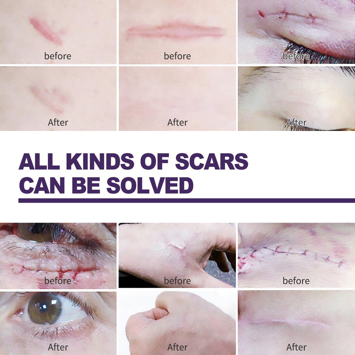 Silicone Scar Patch, Reduces Stretch Marks And Hyperplasia Of Caesarean Section Scars Silicone Patch - V.I.P Digital Presence