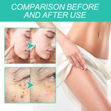 Keyu Liquid Repair Smooth Face Body Skin Deep Cleaning Moles Corns Keyu Liquid Pen - V.I.P Digital Presence