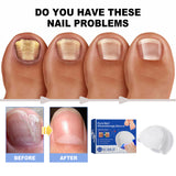 Dispositivo de fototerapia de uñas puro, repara uñas rotas, engrosa y aclara las uñas, limpia suavemente las uñas grises y cuida las uñas.
