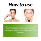 Herbal Acne Serum, Reduce Acne Pimples With A Comprehensive Moisturizing Moisturizer - V.I.P Digital Presence