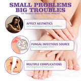 Gray Nail Care Spray Soft Ingrown Nails, Ingrown Nails, Yellowing And Thickening Cleaning Care