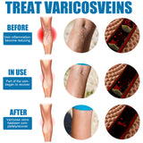 Leg Care Spray Gently Relieve Leg Discomfort, Blue Veins And Bumps Repair Daily Care - V.I.P Digital Presence