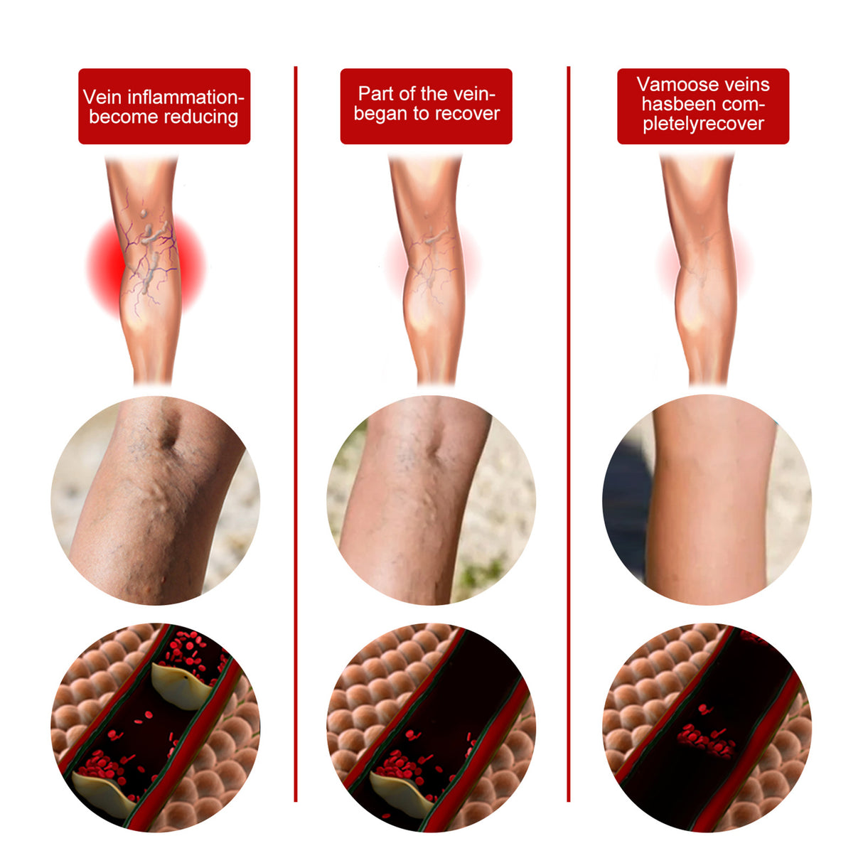 Intravenous Massage Spray For Varicose Veins Relief And Earthworm Leg Blood Vessel Bulge Pain Spray - V.I.P Digital Presence