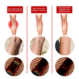 Intravenous Massage Spray For Varicose Veins Relief And Earthworm Leg Blood Vessel Bulge Pain Spray - V.I.P Digital Presence