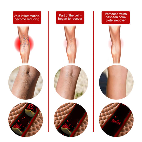 Intravenous Massage Spray For Varicose Veins Relief And Earthworm Leg Blood Vessel Bulge Pain Spray - V.I.P Digital Presence