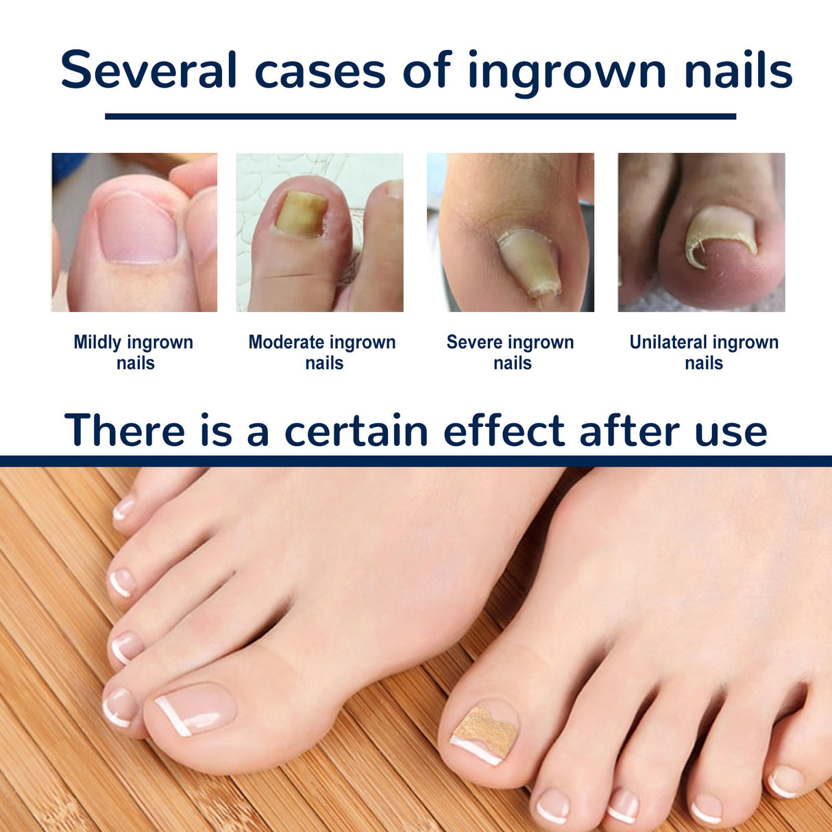 Nail Correction Patch, Nail Insert Correction And Repair Toe Manicure Nail Patch - V.I.P Digital Presence