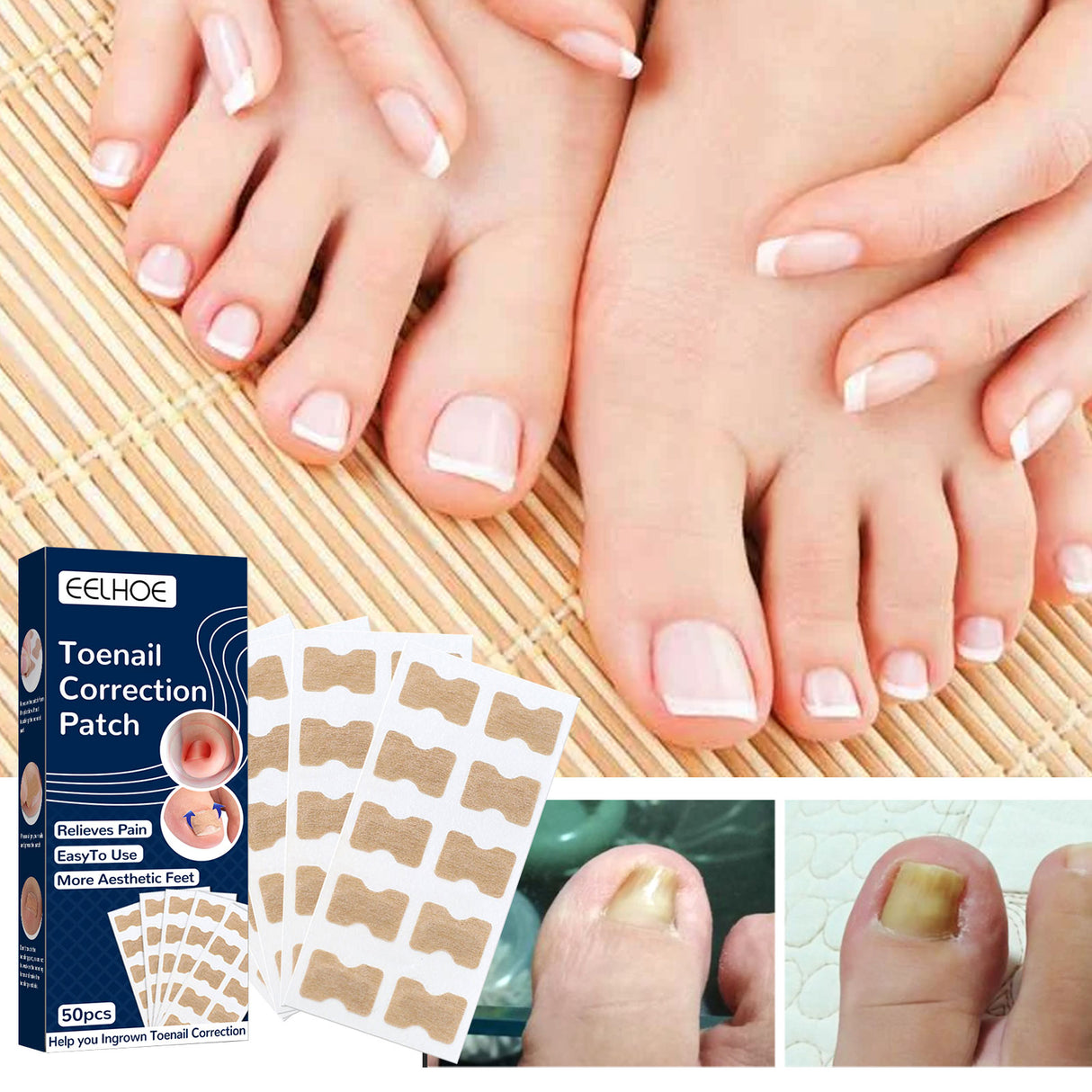 Nail Correction Patch, Nail Insert Correction And Repair Toe Manicure Nail Patch - V.I.P Digital Presence