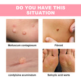 Skin Wart Lotion, Cleanses Skin And Removes Flat Eye Wart Lotion Especially Hand Cocoon - V.I.P Digital Presence