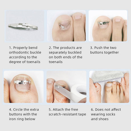 Ingrown Toenail Corrector Tools Pedicure Recover Embed Toe Nail Treatment Professional Ingrown Toenail Correction Foot Care Tool - V.I.P Digital Presence