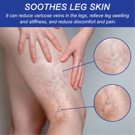 Vein Comfort Spray, Relief Leg Muscle Soreness And Swelling Earthworm Leg Vein Treatment Spray - V.I.P Digital Presence