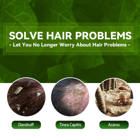 Tinea Capitis Anti-Itch Shampoo Anti-Drop Refreshing Oil Control Hair Care Anti-Dandruff Anti-Itch Shampoo - V.I.P Digital Presence