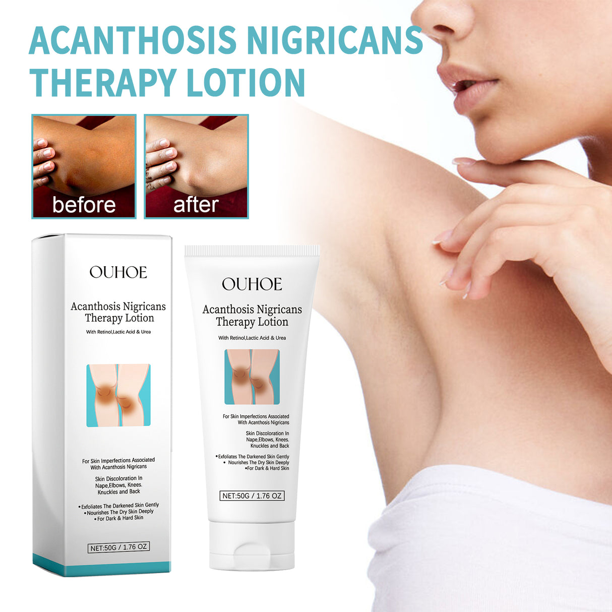 Acanthosis Nigricans Therapy Lotion, Skin Moisturizing Clean Black Dark Heavy Alar Knee Joint Repair Carry Bright Color Of Skin - V.I.P Digital Presence