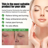 Herbal Eczema Ointment, Relieve Hand And Foot Moss Skin Redness Itchy Skin Repair Ointment - V.I.P Digital Presence