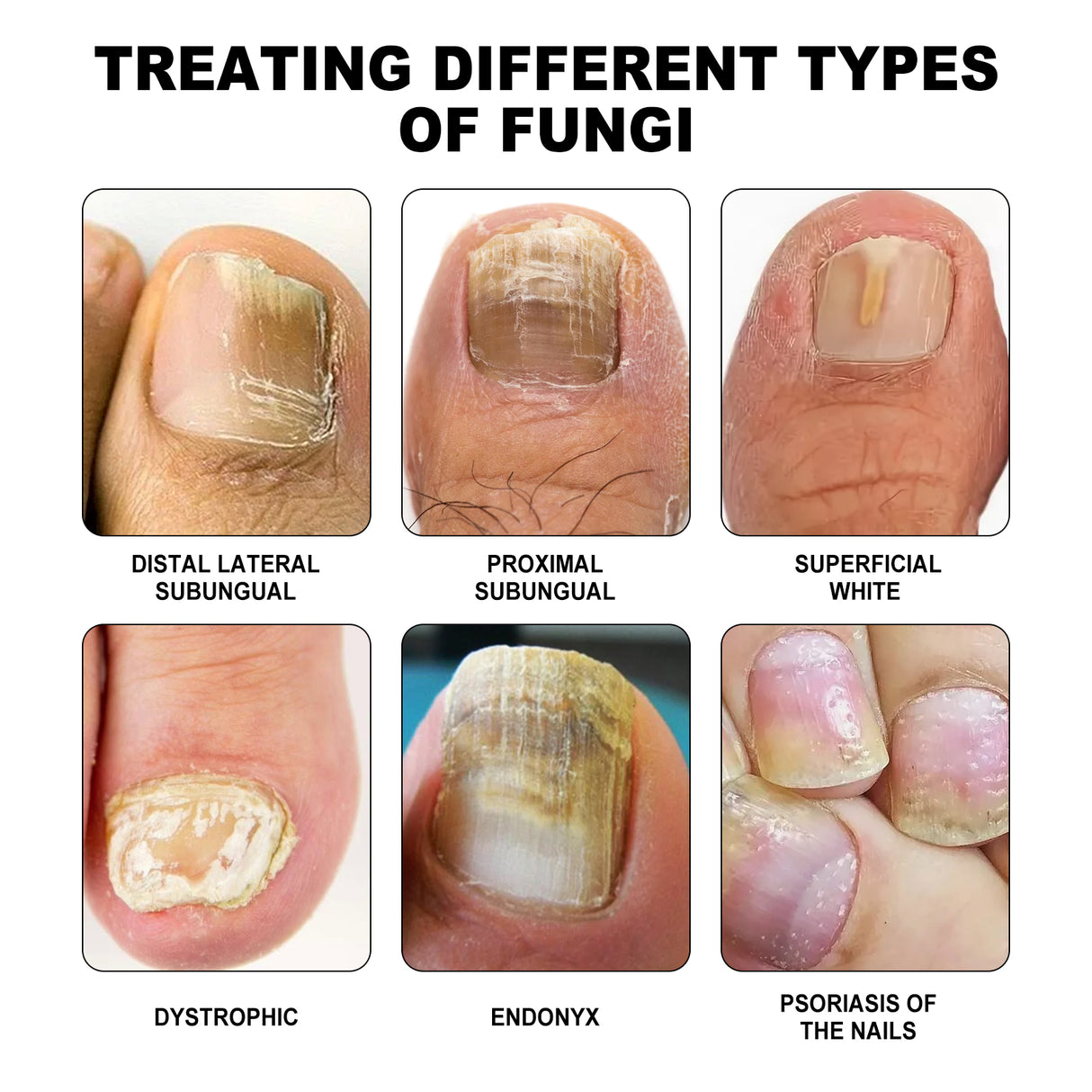 Dispositivo de fototerapia de uñas puro, repara uñas rotas, engrosa y aclara las uñas, limpia suavemente las uñas grises y cuida las uñas.