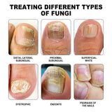 Dispositivo de fototerapia de uñas puro, repara uñas rotas, engrosa y aclara las uñas, limpia suavemente las uñas grises y cuida las uñas.